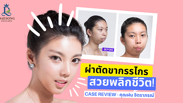 ผ่าตัดขากรรไกรพลิกชีวิต! คุณฝน จิตราภรณ์ – By Banobagi (ตอนที่ 1)