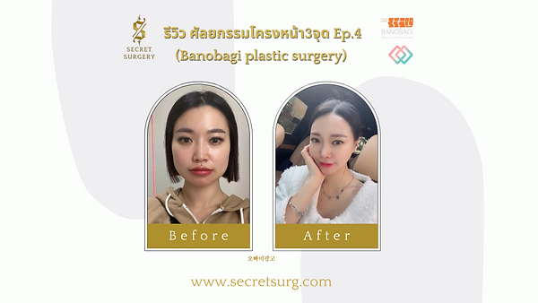 ศัลยกรรมโครงหน้า3จุด ผ่าตัดครั้งเดียวจบ หมดปัญหากังวลใจ ตอนที่ 4