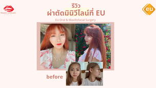 รีวิวผ่าตัดมินิวีไลน์ที่ EU
