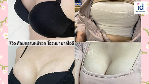 รีวิวศัลยกรรมหน้าอก จากลูกค้าจริง ส่งเข้าประกวดโดย รพ.ID ค่าา (ตอนที่ 1)