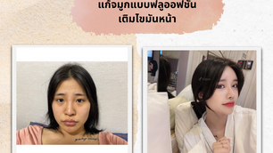 รีวิวศัลยกรรม แก้ตาสองชั้น(เปิดตา3จุด) + แก้จมูกแบบฟลูออฟชั่น + เติมไขมันหน้า