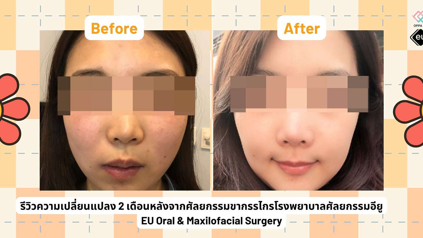 รีวิว ความเปลี่ยนแปลง 2 เดือนหลังจากศัลยกรรมขากรรไกรโรงพยาบาลศัลยกรรมอียู (EU Oral & Maxillofacial Surgery)