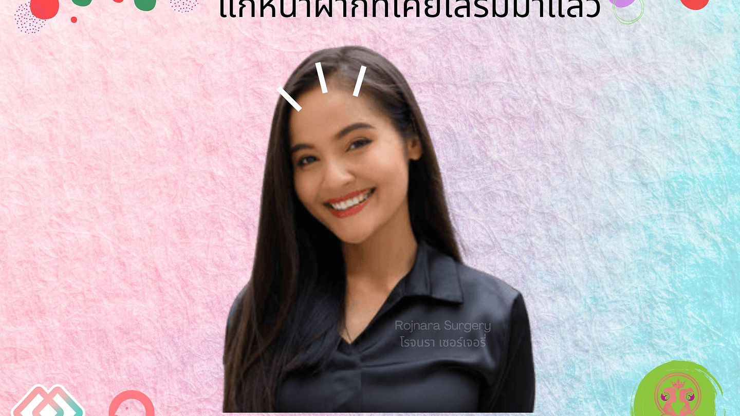 แก้หน้าผากที่เคยเสริมมาแล้ว @Atop Plastic Surgery
