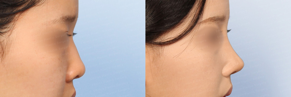 รีวิวเสริมจมูก แก้จมูก โรงพยาบาลศัลยกรรมเอดิชั่น (Edition Plastic Surgery)