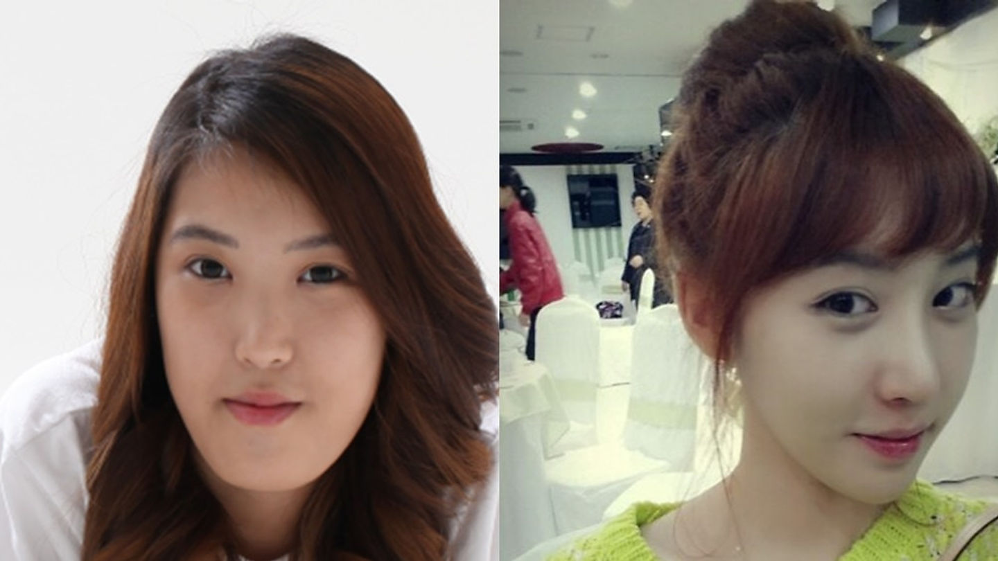 รีวิวศัลยกรรมเกาหลีโรงพยาบาลไอดี ขากรรไกร,จมูก,ปรับไขมันใต้ตา (ตอนที่ 1)