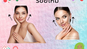 ร้อยไหม @Atop Plastic Surgery