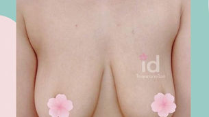 รีวิวหน้าอก จากลูกค้าจริง จาก รพ.ID แบบปังๆค่าา