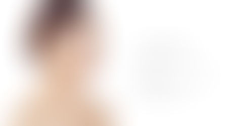 ศัลยกรรมขากรรไกรแบบมินิ ด้วยวิธีการแบบผสมผสาน Banobagi