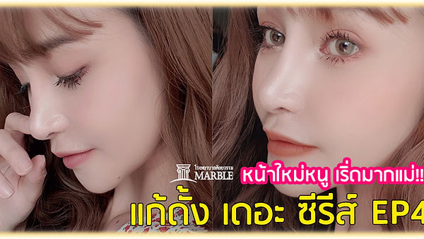 รีวิว【แก้ดั้ง เดอะ ซีรีส์ EP4】เปิดประสบการณ์ครั้งแรกแก้ดั้งใหม่รอบที่ 4 ที่ Marble Plastic Surgery H (ตอนที่ 1)