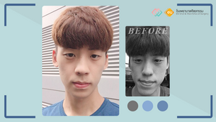 รีวิวผ่าตัดขากรรไกร แก้ปัญหาโครงหน้าเบี้ยว