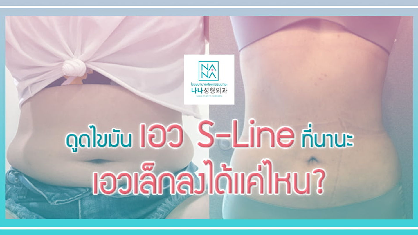รีวิวศัลยกรรม “ดูดไขมัน” เอว S-Line ที่นานะ เอวเล็กลงได้แค่ไหน? (ตอนที่ 1)
