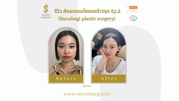 ศัลยกรรมโครงหน้า3จุด ผ่าตัดครั้งเดียวจบ หมดปัญหากังวลใจ ตอนที่ 2