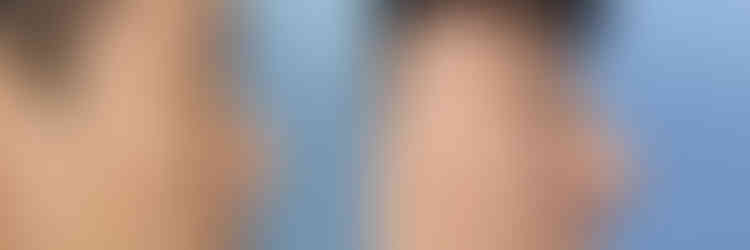 รีวิวเสริมจมูก แก้จมูกผู้ชาย โรงพยาบาลศัลยกรรมเอดิชั่น (Edition Plastic Surgery)