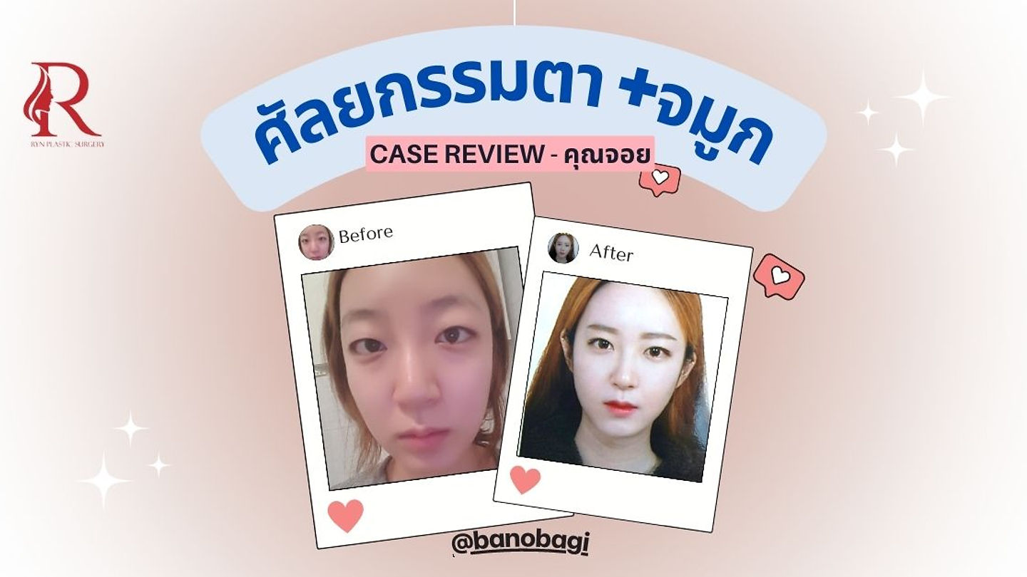 ประสบการณ์ศัลยกรรมตาและจมูก @banobagi (ตอนที่ 1)