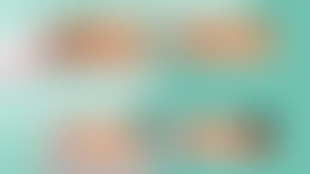 ผู้ชายก็เสริมจมูกได้