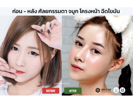 [รีวิวศัลยกรรม] ผ่าตัดโครงหน้า ปรับแก้ชั้นตา เสริมจมูก ฉีดไขมันหน้าเด็ก แก้หน้าอก
