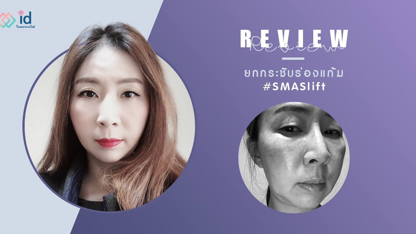 รีวิวยกกระชับ แก้ปัญหาริ้วรอยร่องแก้มและผิวหย่อนคล้อย (ตอนที่ 2)