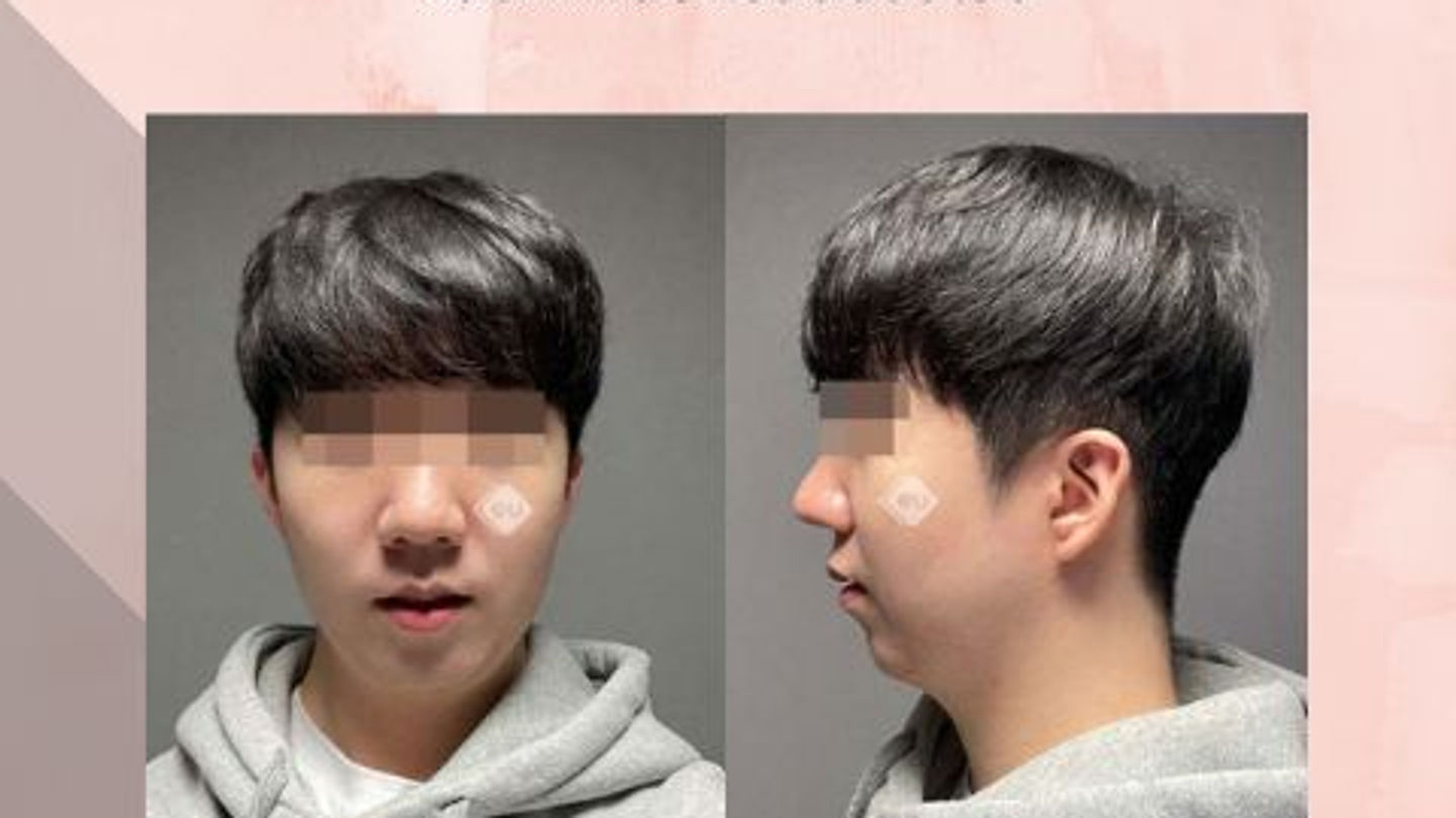 รีวิว ศัลยกรรมมินิวีไลน์ แก้ปัญหาหน้าสั้น โรงพยาบาล EU (ตอนที่ 2)