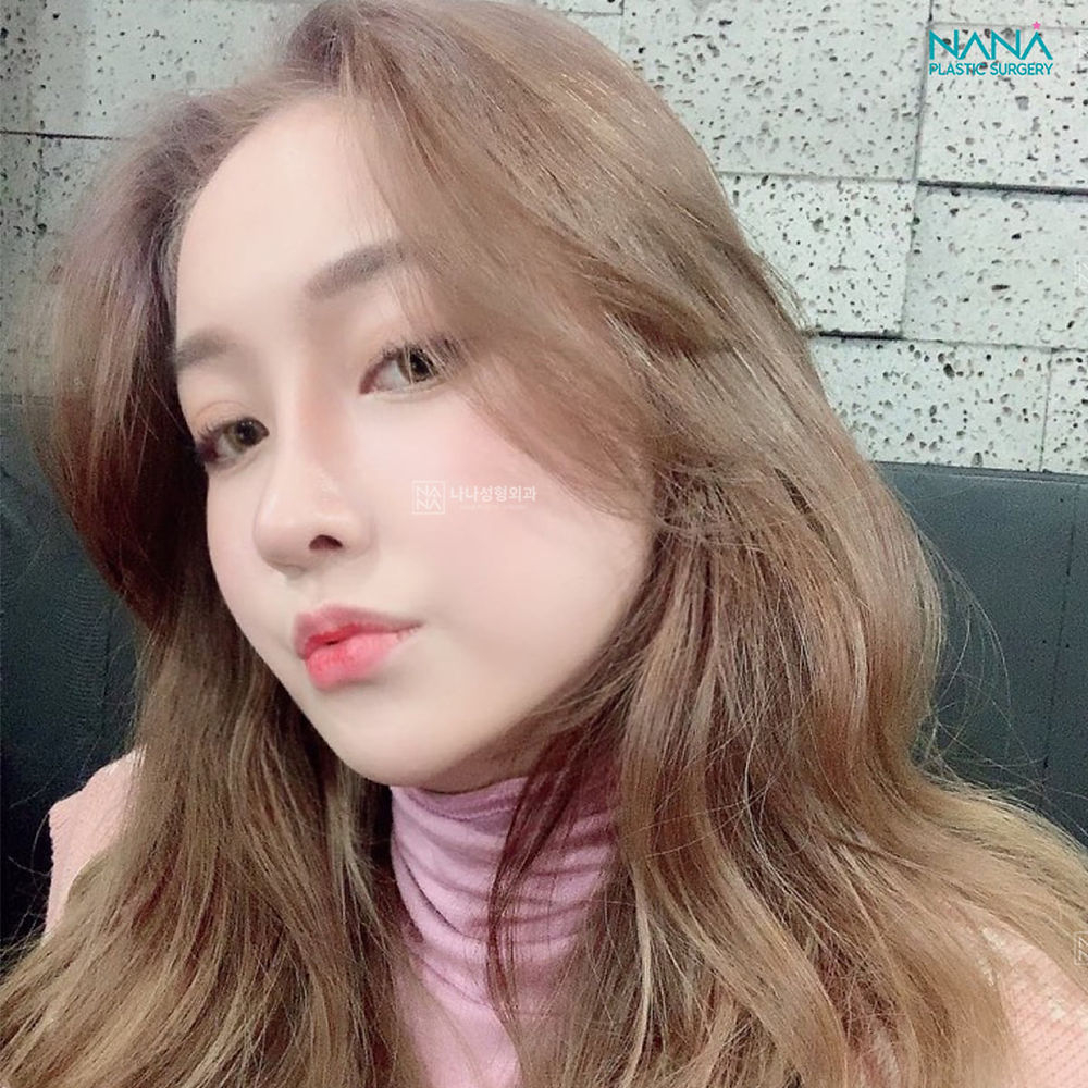 ศัลยกรรมจมูก
