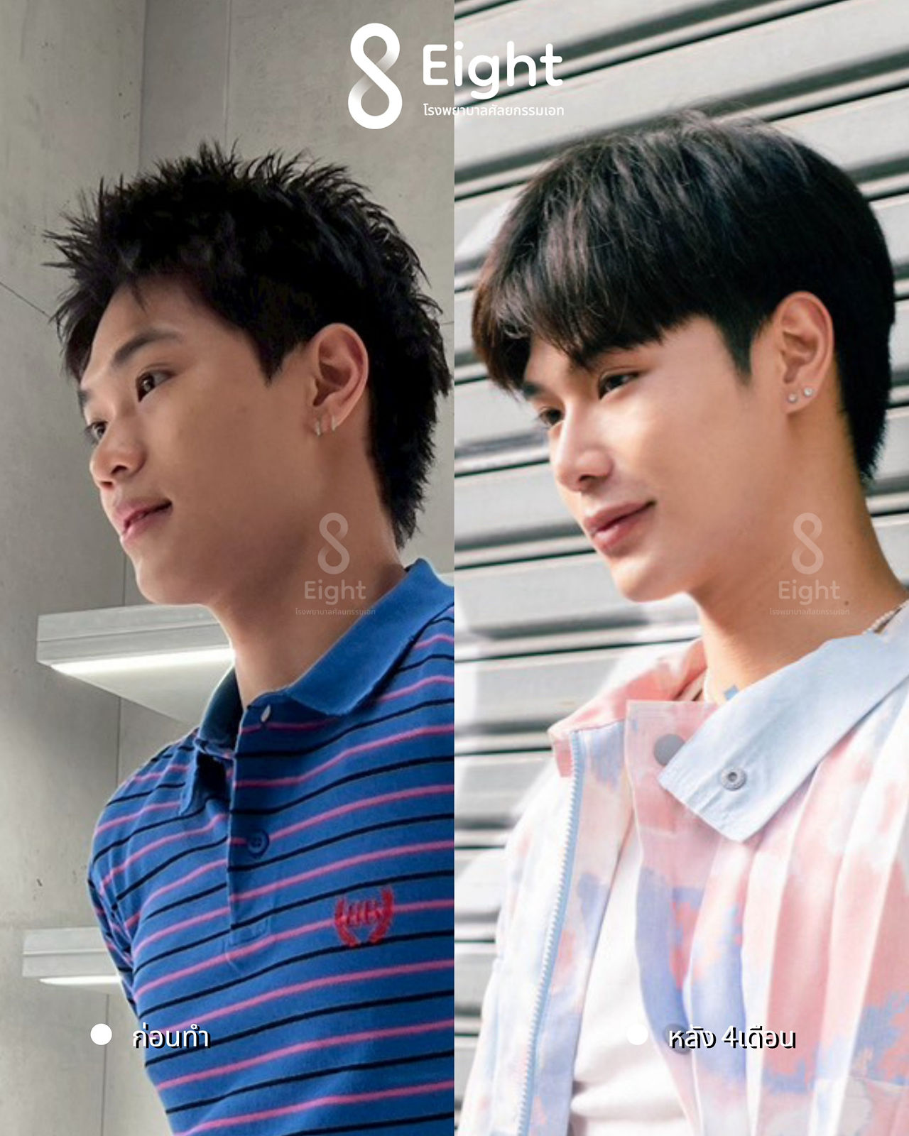 รีวิวศัลยกรรมผู้ชาย โรงพยาบาลศัลยกรรมเกาหลีเอท Eight Plastic Surgery