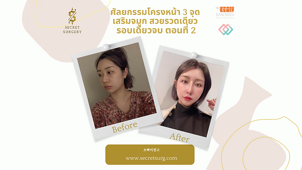 ศัลยกรรมโครงหน้า3จุด เสริมจมูก สวยรวดเดียว รอบเดียวจบ ตอนที่ 2