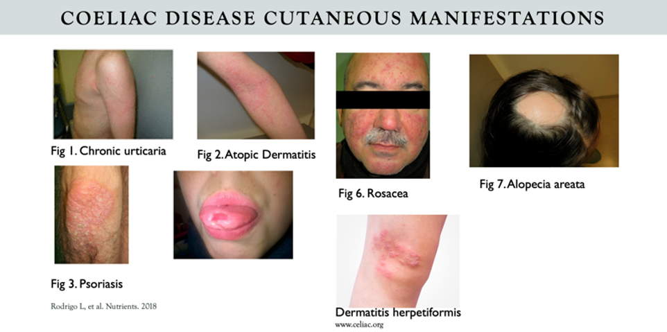 coeliac disease