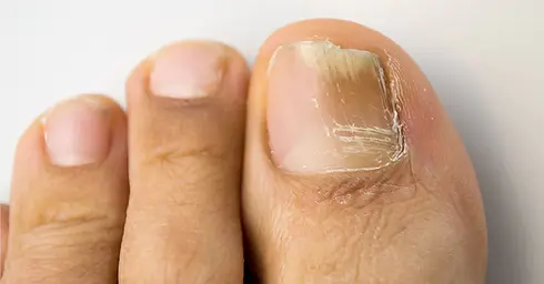 Gebruik voor het behandelen van kalknagels de Vitamine D3 UV lichttherapie Corpusair