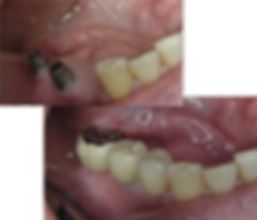 Dental implant back teeth