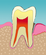 periodontitis gum disease