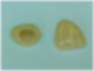 all porcelain dental crown