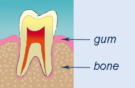 gum periodontal diasease