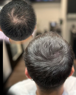 Scalp Micropigmentation