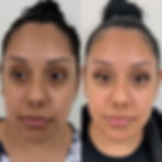 patient who has seen quality med spa injector