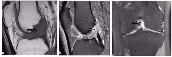 ACL MRI.png