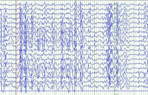 epilepsi tedavi neurofeedback psikiyatri