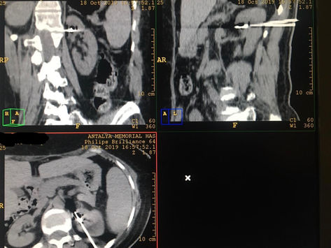 Non-surgical treatment of kidney tumors microwave ablation