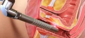 Ameliyatsız Lazerle Vajinal Daraltma, Beyazlatma