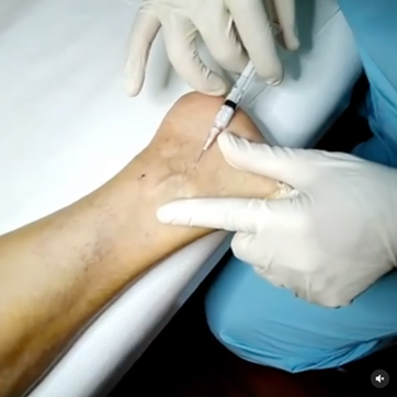 Prof.Dr.Aykut R Aktaş-Laser Spataderen-Sclerotherapie