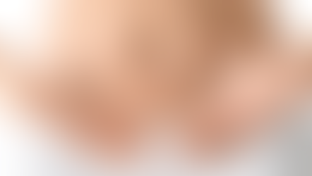 Polikistik Over Sendromu