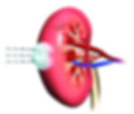 Kidney Tumor Ablation