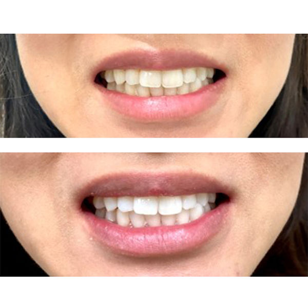 Before and after images showcasing a patient's teeth transformation with professional teeth whitening treatment.
