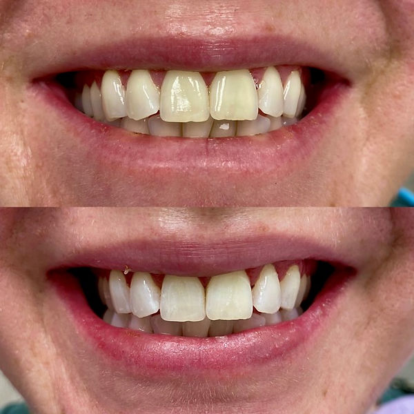 Close-up of a patient receiving in-office teeth whitening procedure at Flash DentSpa.