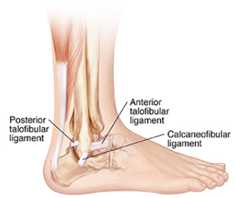 Can an Ankle Sprain be Fixed? 