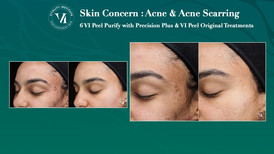 VI Peel Skin Concern_ Acne3.jpeg