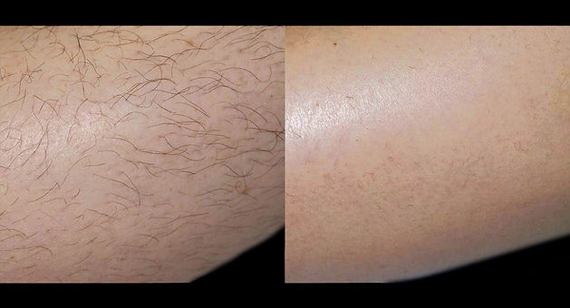laser_hair_removal_leg2.jpg