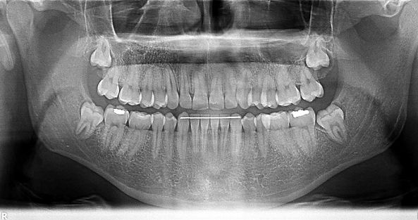 Wisdom Teeth Extraction
