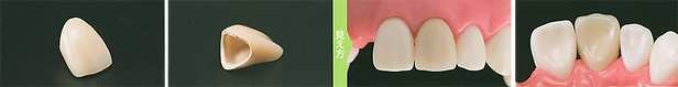 セラミッククラウン