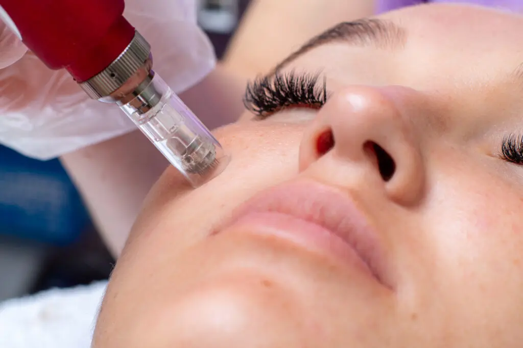 Microneedling.webp