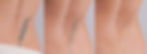 Tattoo Verwijderen