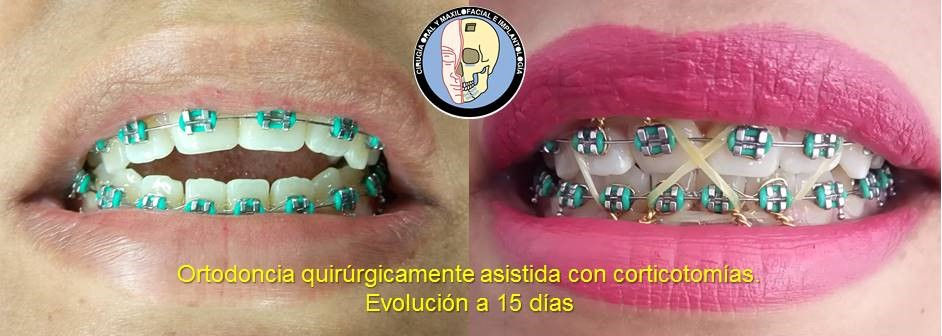 Mordida abierta anterior